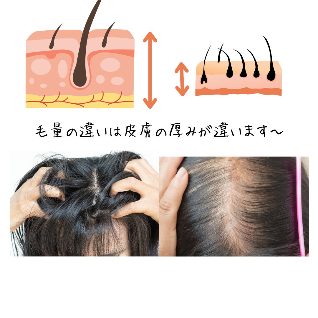 【毛量の違いは“頭皮の厚み”で決まります】